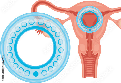 Anatomical illustration of a hormonal contraceptive ring in the female reproductive system showing its placement in the vagina and uterus.