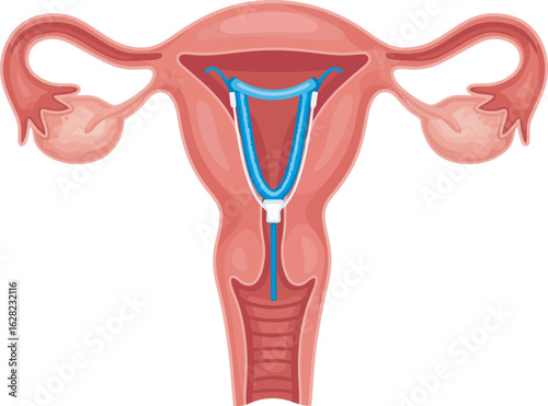 Anatomical illustration of a female uterus with a blue intrauterine device IUD inserted for birth control.