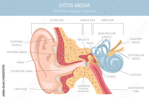 Otitis media. Infection in the middle ear. Otological disorders infographic. Vector illustration