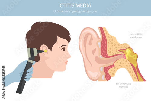 Otitis media. Infection in the middle ear. Otological disorders infographic. Vector illustration