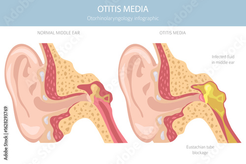 Otitis media. Infection in the middle ear. Otological disorders infographic. Vector illustration