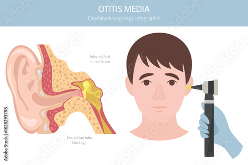 Otitis media. Infection in the middle ear. Otological disorders infographic. Vector illustration