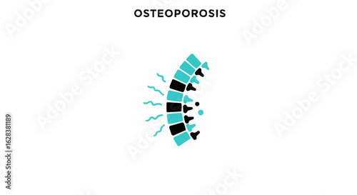 Illustration of osteoporosis with spinal diagram, illustrating the weakening of bones.