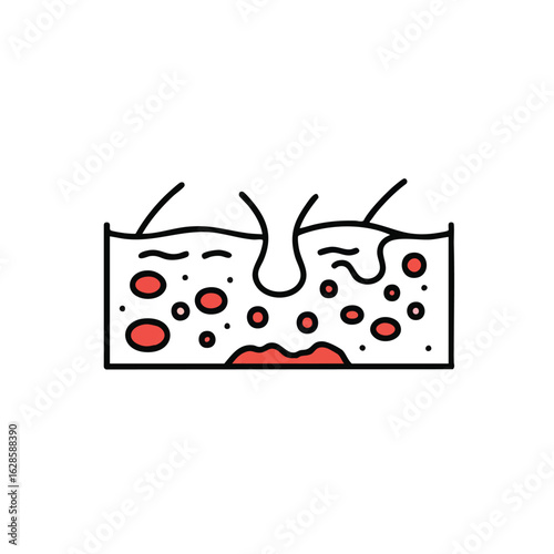 Scientific illustration showcasing a cross-section of the human skin, highlighting a pore alongside inflamed areas, symbolizing dermatological concerns or conditions.