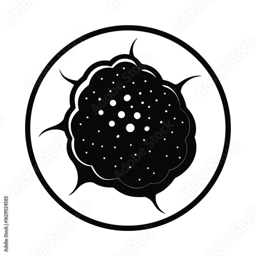 Pearly Nodular Lesion Typical of Basal Cell Carcinoma