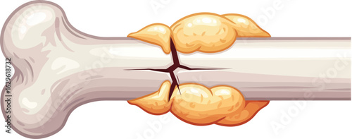 Stylized illustration of a healing bone fracture with a prominent yellow bony callus formation.