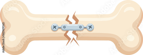 Stylized fractured bone held together by a surgical metal plate and screws.