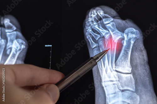 Doctor learn Medical X-ray with leg toe dislocations. Hook-shaped deformity of the finger. Lisfranc joint, Foot fractures.