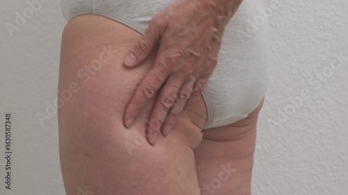 Overweight woman in underwear examines her thighs. Cellulite, lipedema, stretch marks on the skin, veins, folds on the buttocks are visible. Body positivity, obesity, weight loss, liposuction, diet.