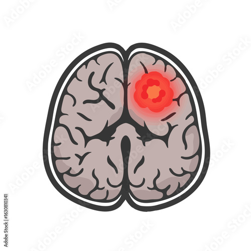 Vector illustration of brain tumor scan on white background
