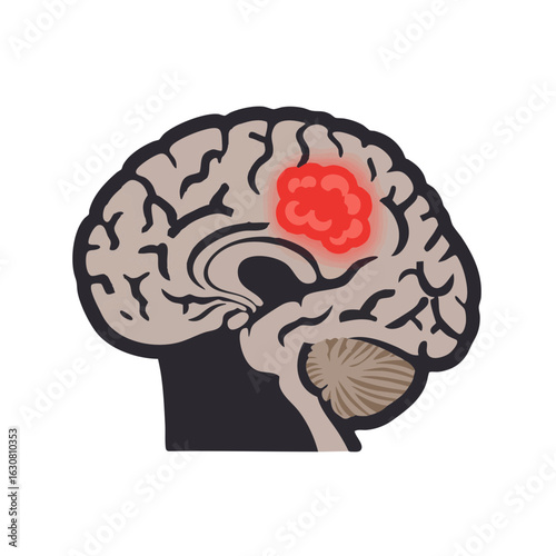 Vector illustration of brain tumor scan on white background