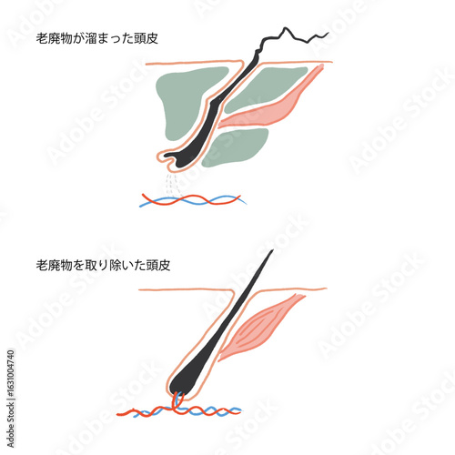 老廃物がたまった頭皮にと正常な頭皮のイラスト