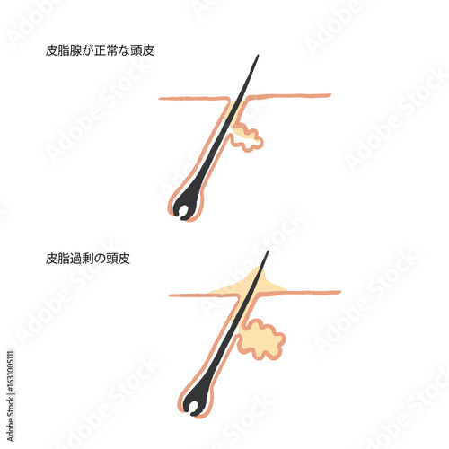 毛根、皮脂トラブルの手書きイラスト