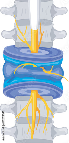 Anatomical illustration of a bulging intervertebral disc causing nerve compression.