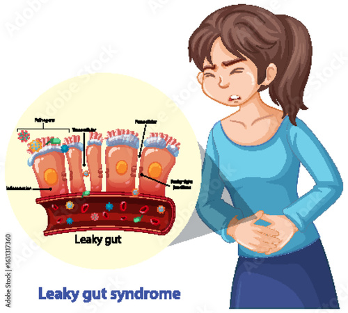 Woman Experiencing Leaky Gut Syndrome with Medical Diagram