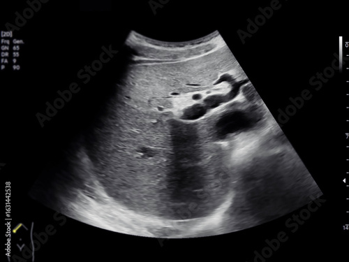A normal ultrasound of the upper abdomen, showing healthy organs with no abnormalities. Clear imaging of the liver, pancreas, and surrounding structures.