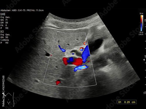 A normal ultrasound of the upper abdomen, showing healthy organs with no abnormalities. Clear imaging of the liver, pancreas, and surrounding structures.