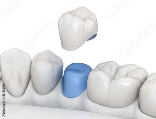 Porcelain crown placement over premolar tooth. 3D illustration