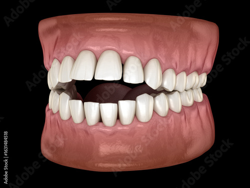 Openbite dental occlusion ( Malocclusion of teeth ). 3D illustration