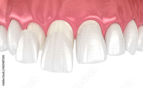 Dental veneers on blue background. 3D illustration
