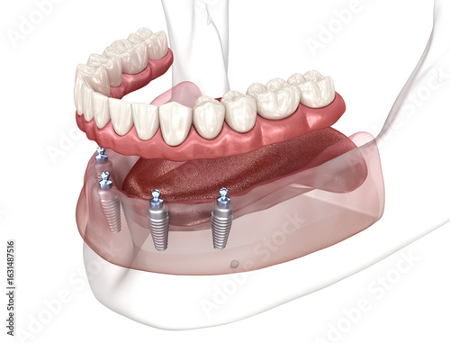 Dental prosthesis based on 4 implants. Dental 3D illustration