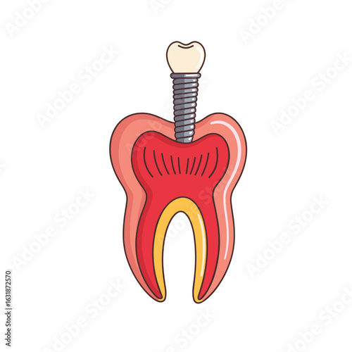 Dental implant illustration of tooth with screw and roots  