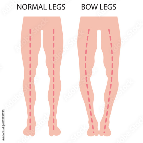 Flat vector illustration of bow legs and knock knees in children and young people, showing symptoms like leg curvature and posture issues, with similarities to rickets and Blount’s disease.
