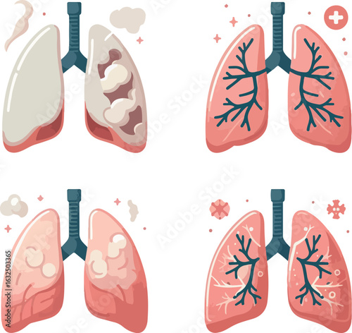 Set of Human Lungs Conditions - Medical Vector Illustration