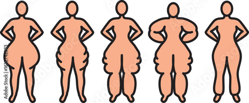 Foto Vector icons of lipedema types of women's body