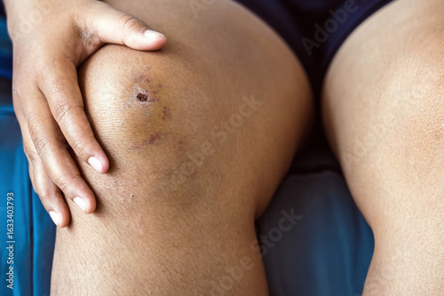 Quadro su tela Young woman has bruises and scabs on knees from a fall