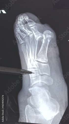 Vertical footage of doctor learn Medical X-ray with leg toe dislocations. Hook-shaped deformity of the finger. Lis franc joint, Foot fractures. 4k footage.