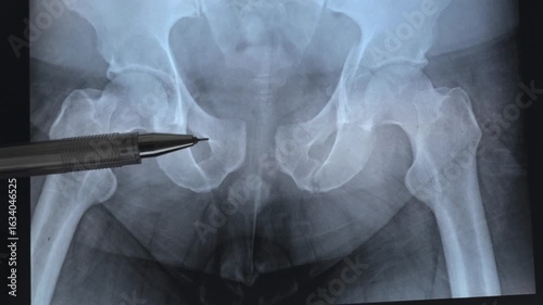 Doctor learn Medical X-ray of pelvic bones fractures after accident. 4k footage