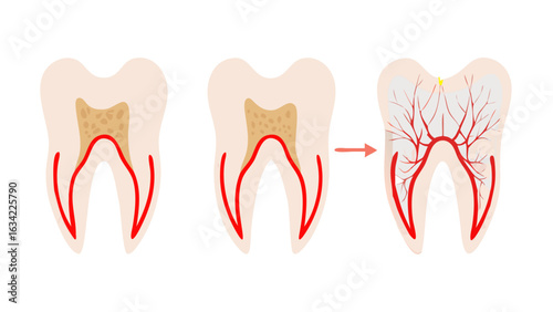 Understanding tooth anatomy through stages of dental health, illustrating the progression from healthy to infected roots