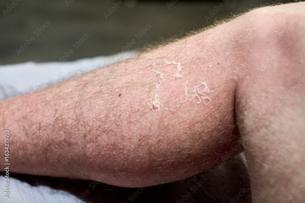 Fototapeta premium Close-up of arm shows peeling skin due to sunburn. Indoor lighting highlights texture and redness. Background slightly blurred, focus on peeling area