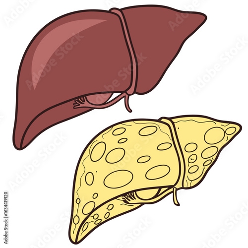 Healthy And Diseased Liver Anatomy Illustration