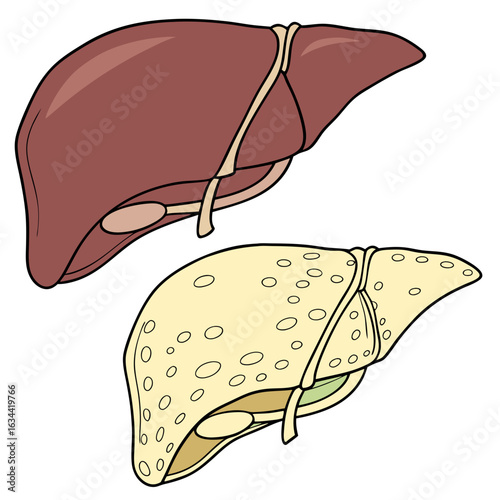 Human Liver Anatomy Illustration: Healthy Versus Diseased Comparison