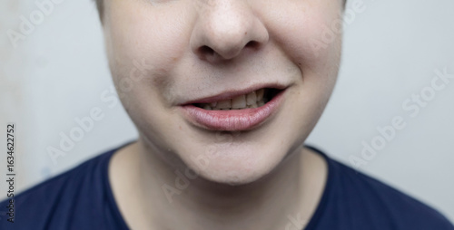Close-up of a young person showing facial asymmetry, characteristic of facial nerve palsy (Bell's palsy). Concept of neurological disorder, facial paralysis, or nerve inflammation.