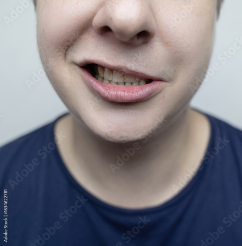 Close-up of a young person showing facial asymmetry, characteristic of facial nerve palsy (Bell's palsy). Concept of neurological disorder, facial paralysis, or nerve inflammation.
