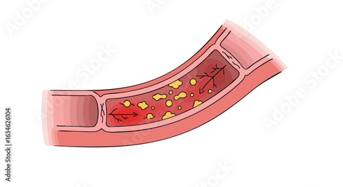 Vector Medical Illustration of Artery Blockage in Modern Organic Style with Red and Yellow Colors for Healthcare Design