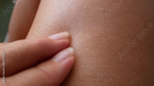 mosquito bites ticks on woman's legs, big red spots on skin, Lyme disease,  closeup