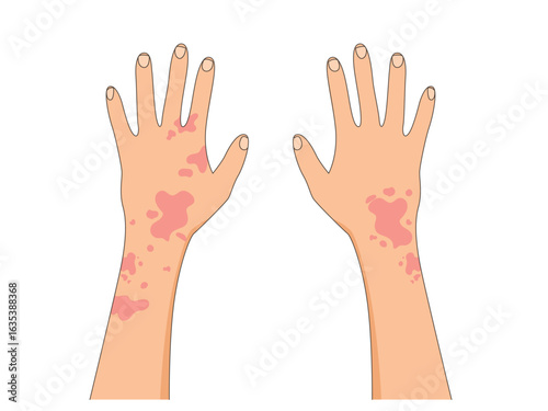 Hand with psoriasis wounds, psoriasis skin rash