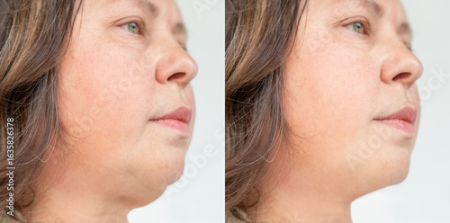 Photos Woman before and after cosmetic treatment, double chin removal, sagging skin car