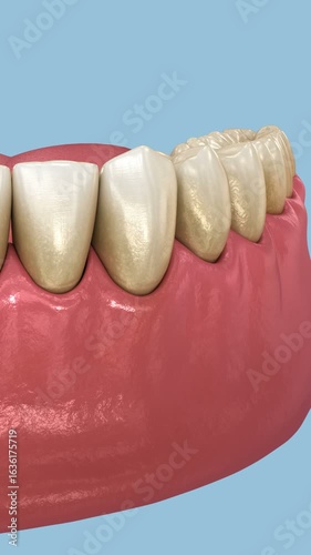 Periodontal - pathological inflammatory condition of the gum in progress. Dental 3D Animation