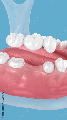 Dental bridge based on 2 teeth. 3D Animation