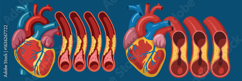 Healthy Heart And Arteries Versus Atherosclerosis Blockage human anatomy