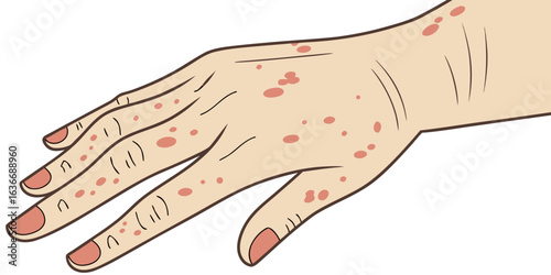 Hand with rash offers visual aid for medical professionals discussing skin conditions and infectious diseases