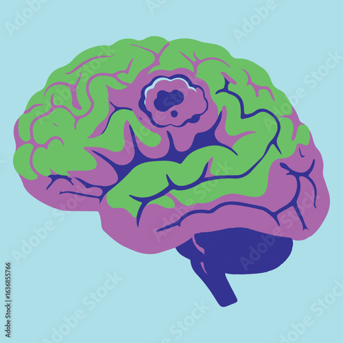 Stylized illustration of a human brain with a malignant tumor. Medical vector graphic for neurology and oncology concepts.