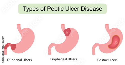 Types of Peptic Ulcer Disease - Duodenal, Esophageal, and Gastric Ulcers llustration. Editable Vector stroke EPS10 Medical infographics.