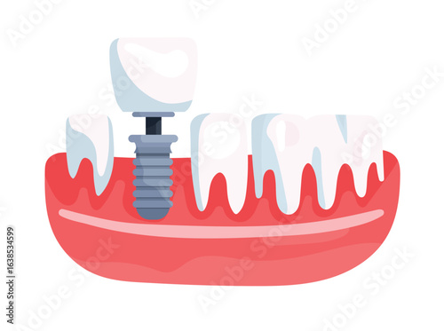 Model of the jaw part with a row of teeth and a dental implant. Installation of a crown. Flat vector clipart, illustration with isolated background.