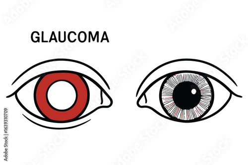 glaucoma eye symptoms illustration with red eye and optic nerve damage, eye care awareness, vision loss, glaucoma treatment illustration